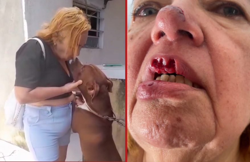 Woman bitten in face after trying to kiss pit bull - Brazil