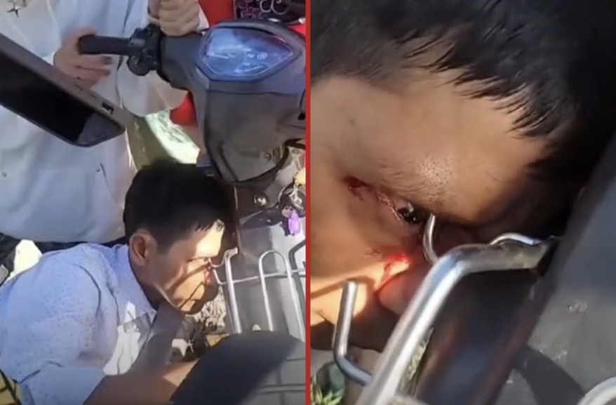 Motorcycle incident leaves young man injured after metal luggage hook penetrates his eye socket - Vietnam