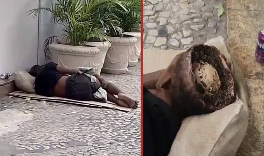 Homeless man found in critical condition in Tijuca with severe cranial exposure - Brazil