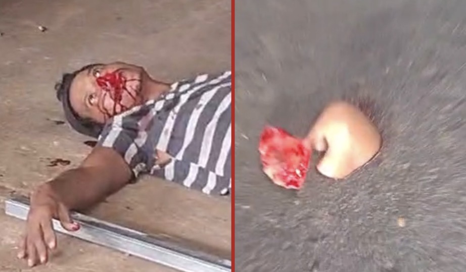 Worker’s nose completely torn off after gas cylinder explodes during cutting operation - Brazil
